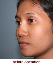 plastic_surgery_augmentation_rhinoplasty